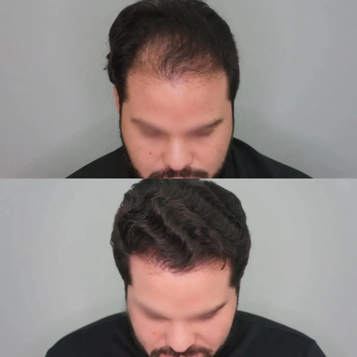 Antes e depois de transplante capilar FUE — caso 1