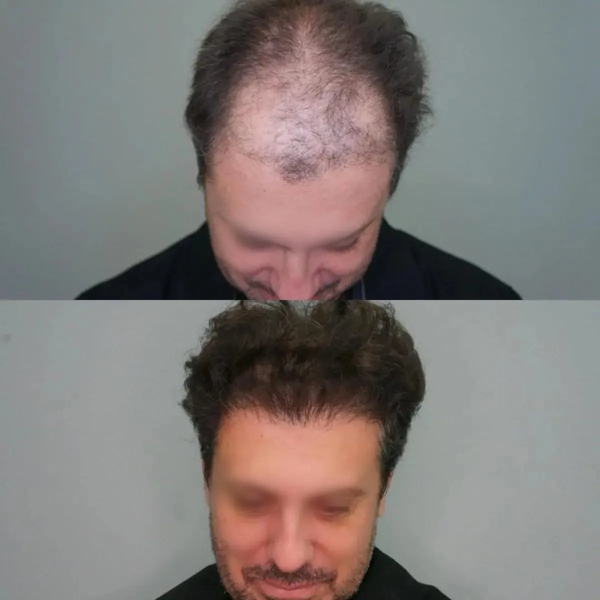Antes e depois de transplante capilar FUE — caso 2