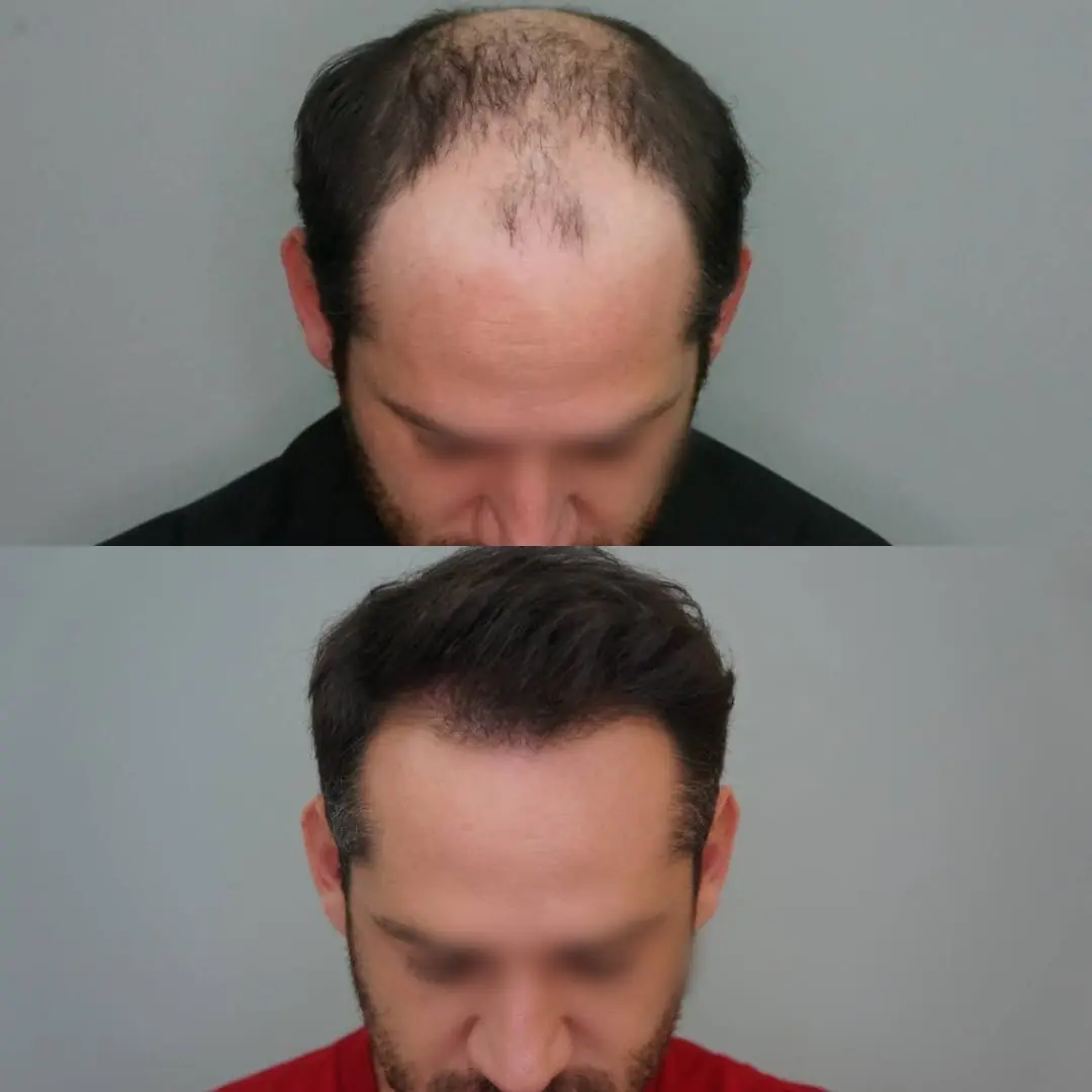 Antes e depois de transplante capilar FUE — caso 3