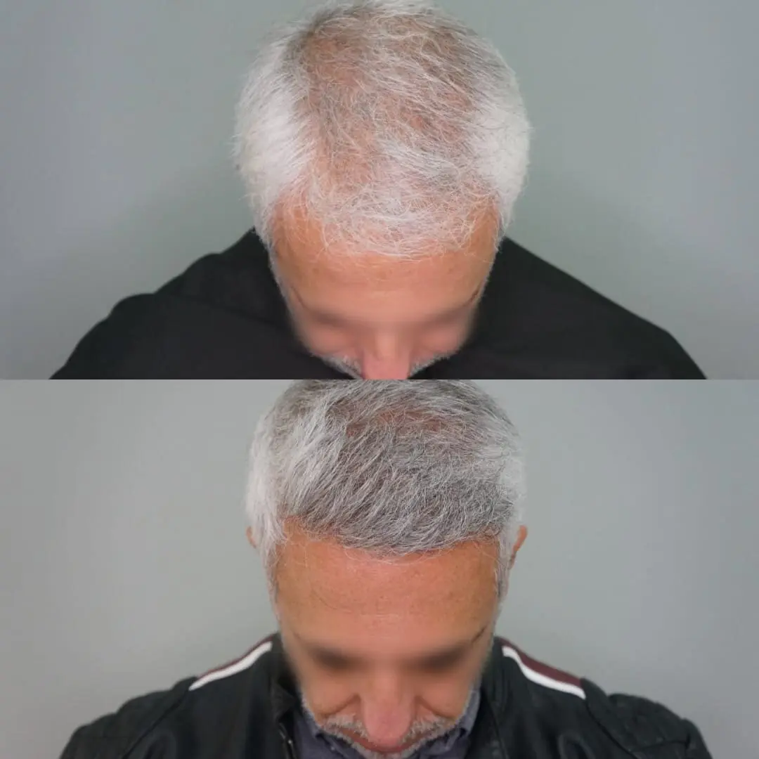 Antes e depois de transplante capilar FUE — caso 4