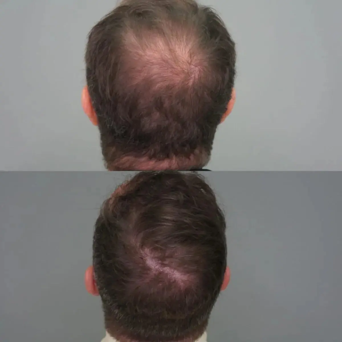 Antes e depois de transplante capilar FUE — caso 5