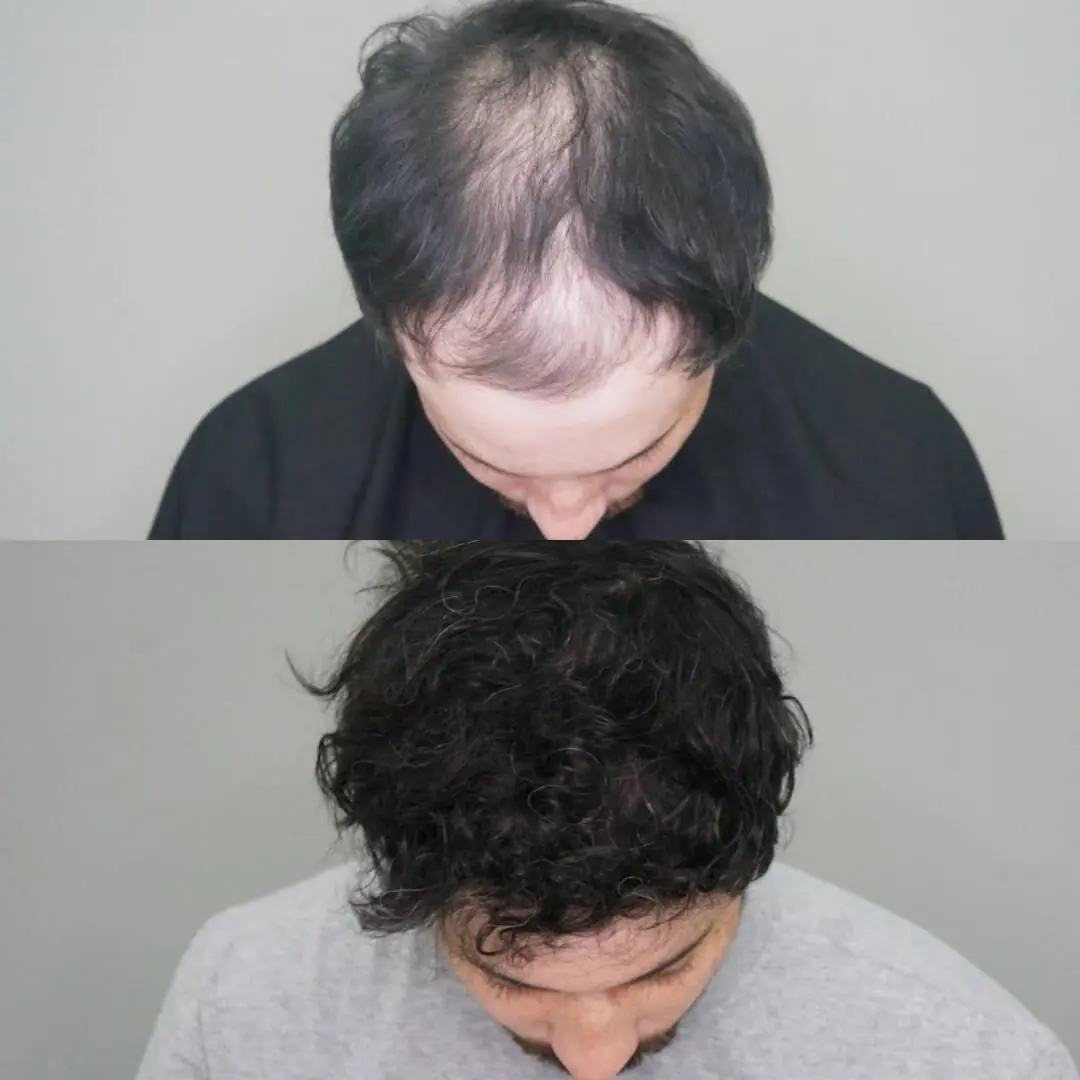 Antes e depois de transplante capilar FUE — caso 6